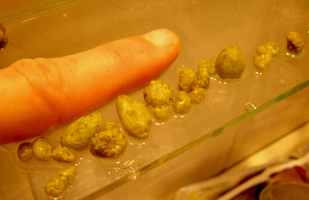 C&aacute;lculos Biliares